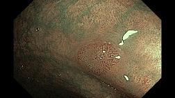 "Valley sign" (симптом желобка) - эндоскопический признак мелких аденом толстой кишки